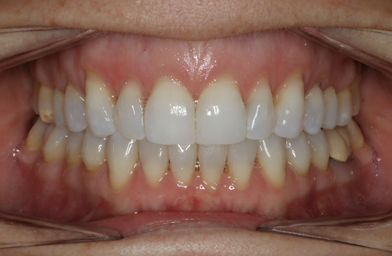 3 despues de ortodoncia invisible clinica dentisana ruzafa