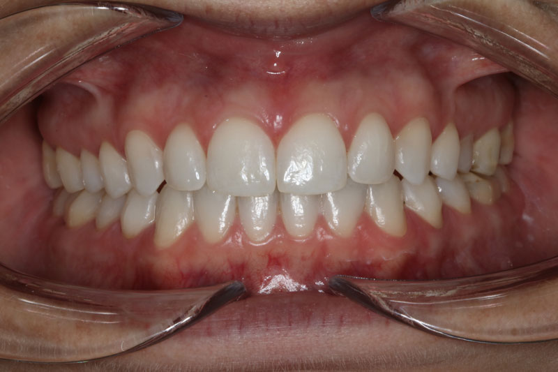 4 despues de ortodoncia invisible clinica dentisana ruzafa