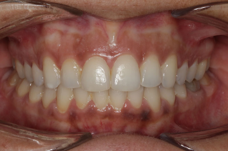 6 despues de ortodoncia invisible clinica dentisana ruzafa