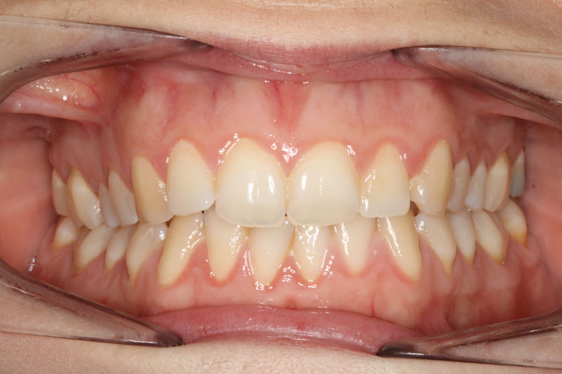 antes de ortodoncia invisible invisalign 2 clinica dentisana ruzafa