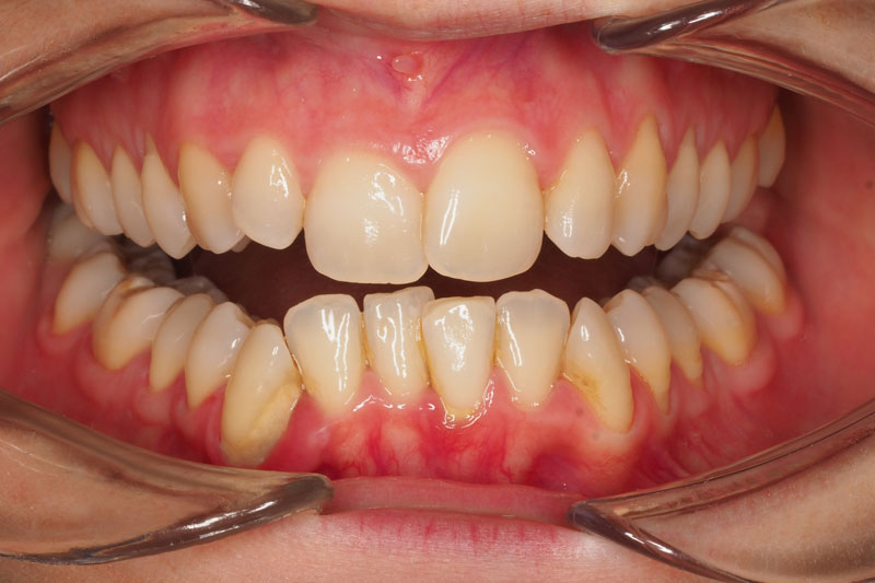 antes de ortodoncia invisible invisalign 4 boca abierta clinica dentisana ruzafa