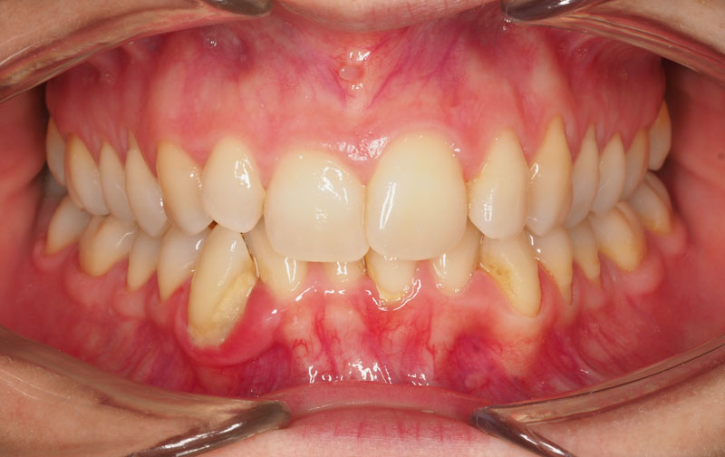 antes de ortodoncia invisible invisalign 4 clinica dentisana ruzafa