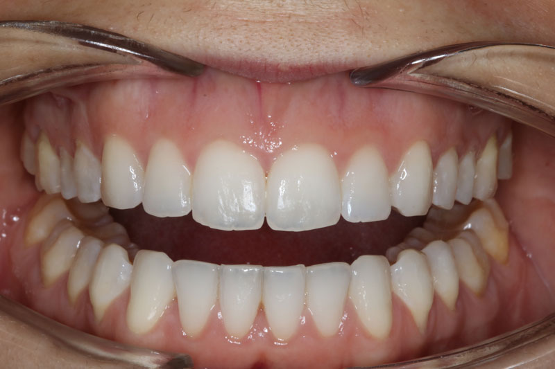 despues de ortodoncia invisible invisalign 2 boca abierta clinica dentisana ruzafa