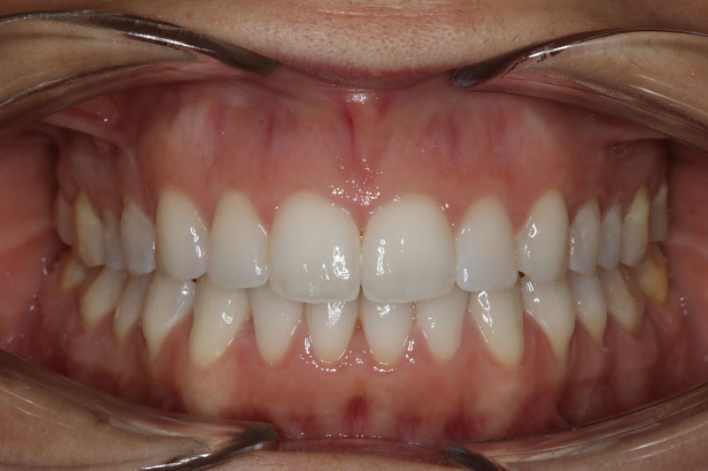 despues de ortodoncia invisible invisalign 2 clinica dentisana ruzafa