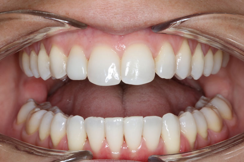 despues de ortodoncia invisible invisalign 4 boca abierta clinica dentisana ruzafa