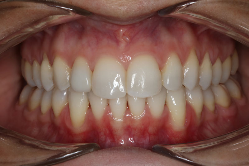 despues de ortodoncia invisible invisalign 4 clinica dentisana ruzafa