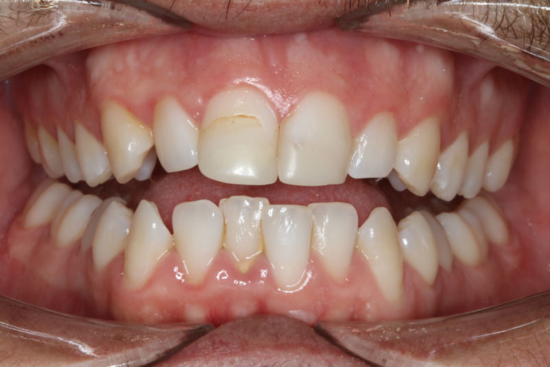 antes de ortodoncia invisible invisalign boca abierta clinica dentisana ruzafa