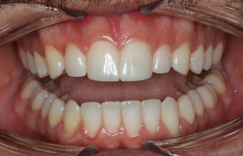 despues de ortodoncia invisible invisalign boca abierta clinica dentisana ruzafa