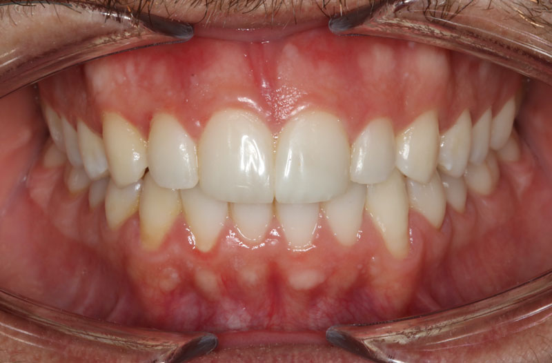 despues de ortodoncia invisible invisalign clinica dentisana ruzafa