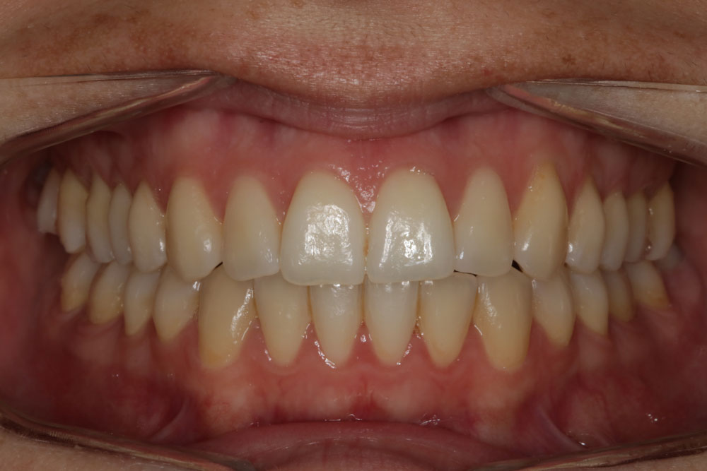 resultados ortodoncia invisible 6 meses clinica dental dentisana ruzafa valencia