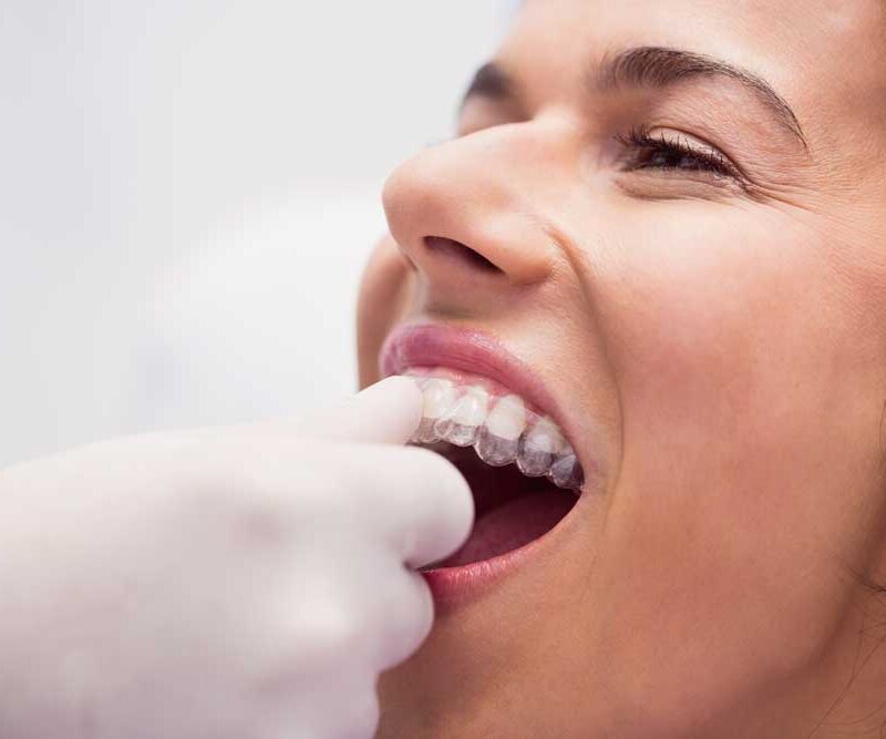 6 mejores marcas ortodoncia invisible clinica dental dentisana ruzafa valencia