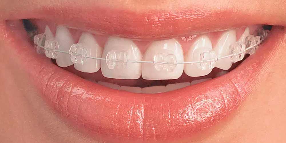 ventajas de brackets esteticos valencia