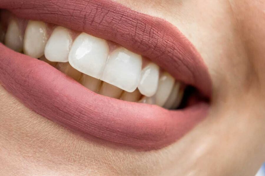 tipos de blanqueamiento dental dentisana clinica dental en ruzafa valencia