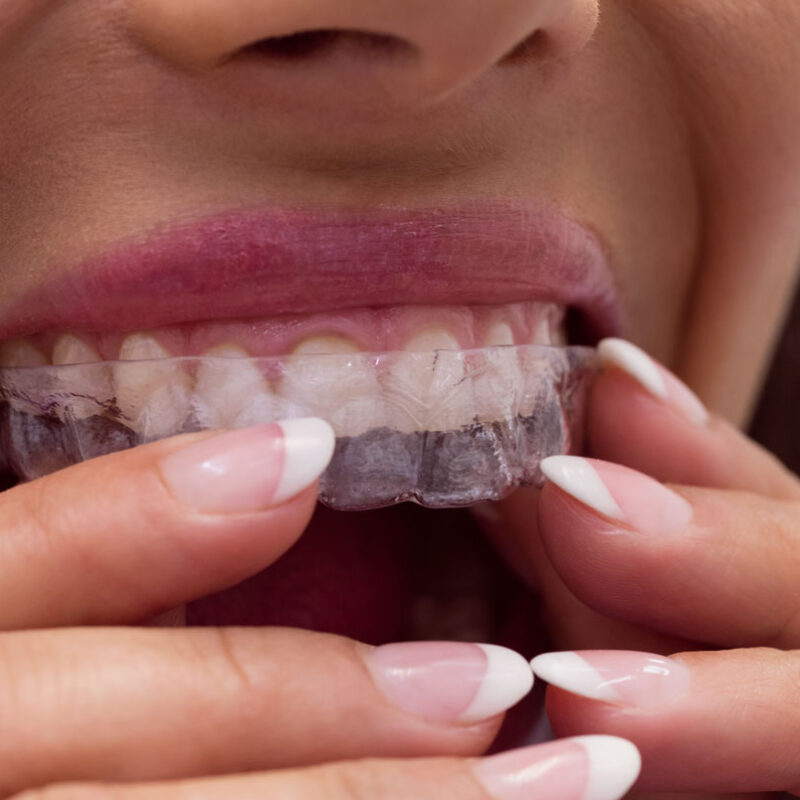 cada cuanto se cambian los alineadores invisibles en valencia dentisana clinica dental en ruzafa valencia