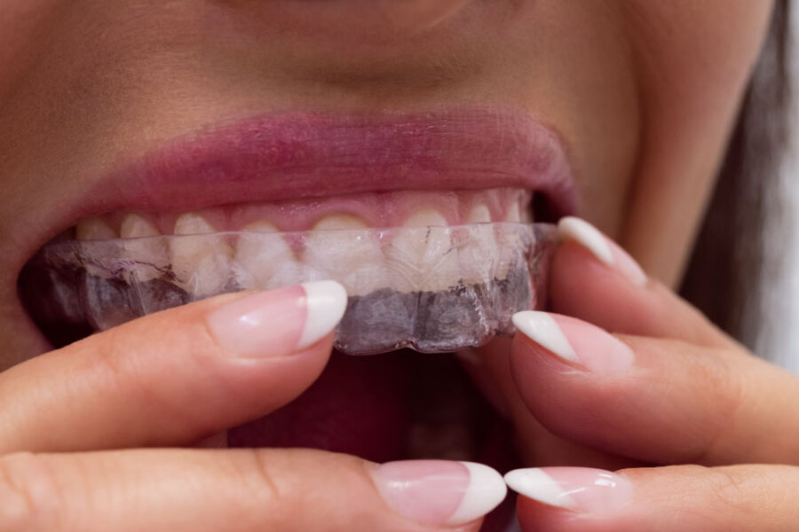 cada cuanto se cambian los alineadores invisibles en valencia dentisana clinica dental en ruzafa valencia