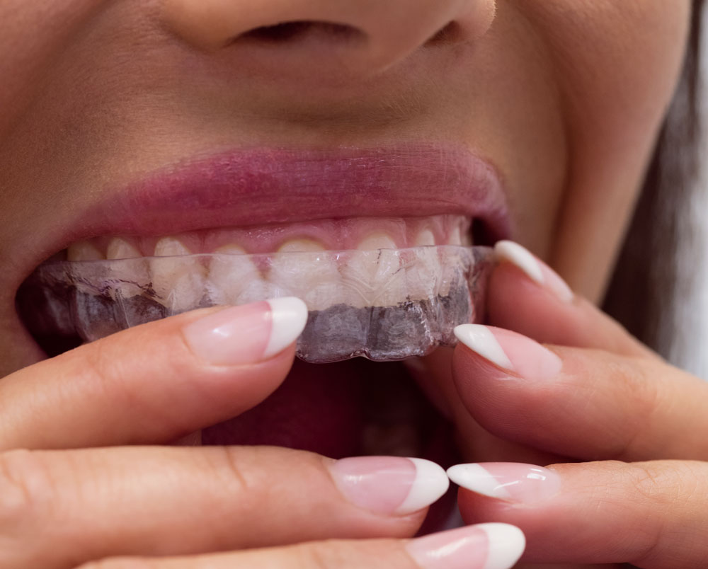 cada cuanto se cambian los alineadores invisibles en valencia dentisana clinica dental en ruzafa valencia