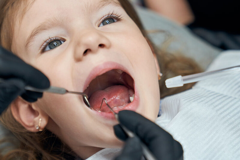 caries en dientes de leche causas sintomas y tratamiento dentisana clinica dental en ruzafa valencia