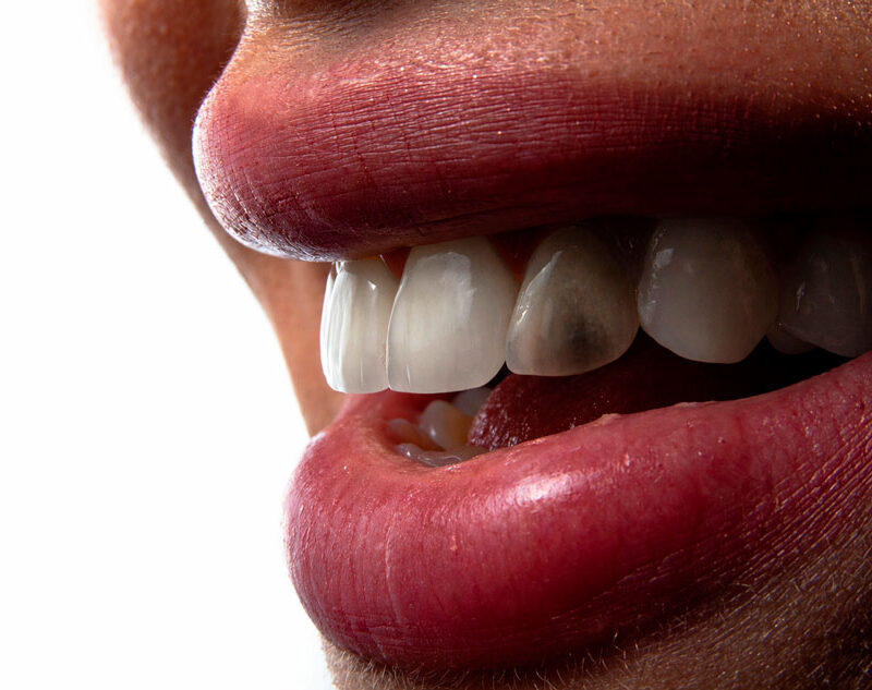 necrosis dental que es causas sintomas y tratmiento dentisana clinica dental en ruzafa valencia
