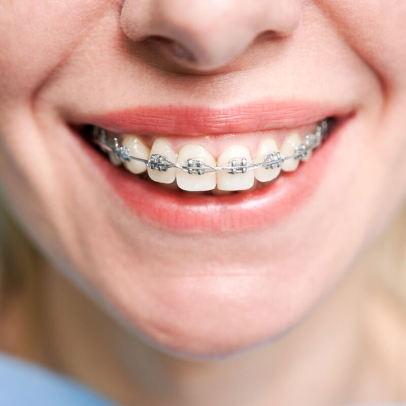 brackets autoligables que son tratamiento y sus ventajas dentisana clinica dental en ruzafa valencia