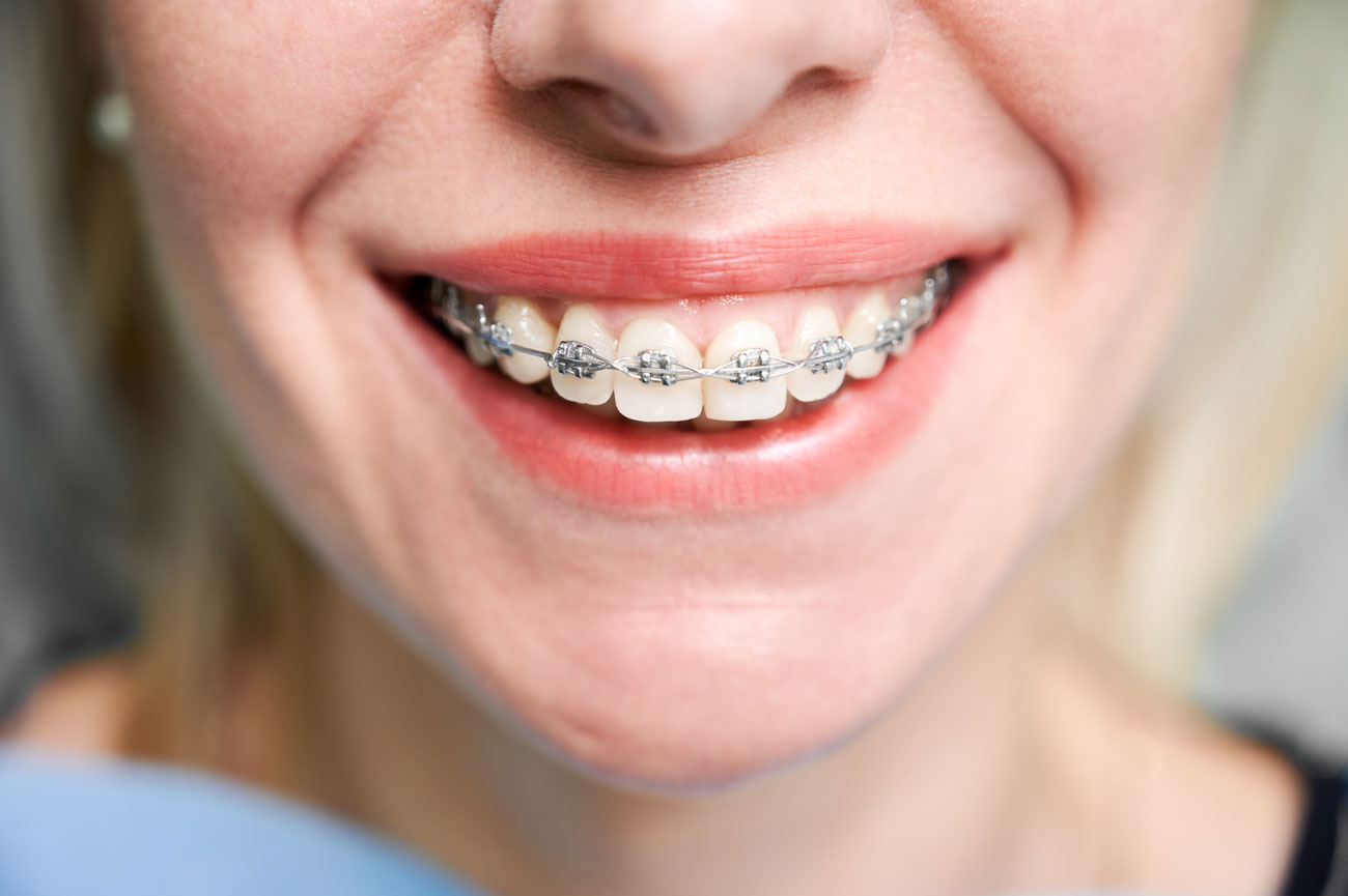 brackets autoligables que son tratamiento y sus ventajas dentisana clinica dental en ruzafa valencia
