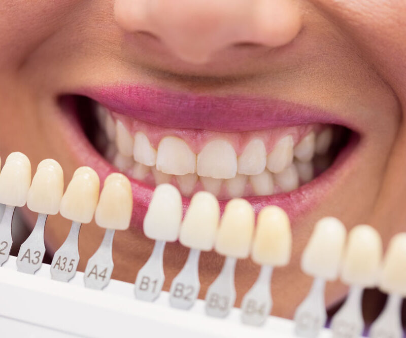 precio del blanqueamiento dental en valencia dentisana clinica dental en ruzafa