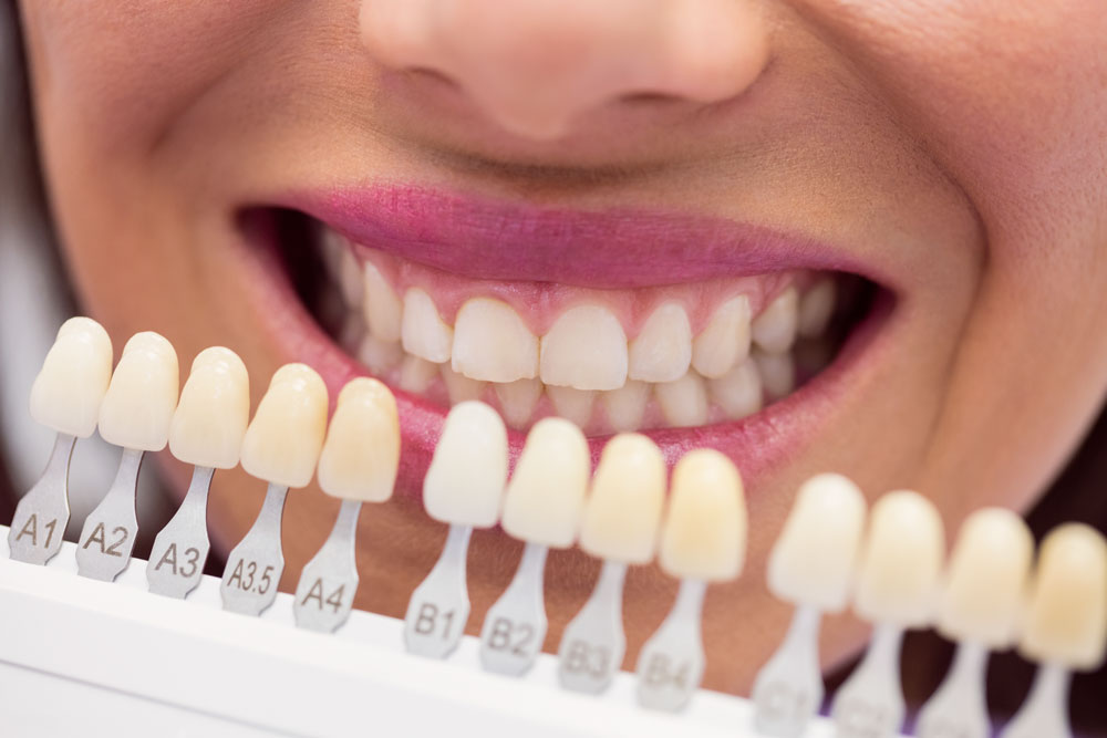 precio del blanqueamiento dental en valencia dentisana clinica dental en ruzafa